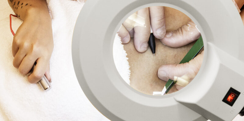 Elektroepilation - entfernt endgültig unerwünschte Haare